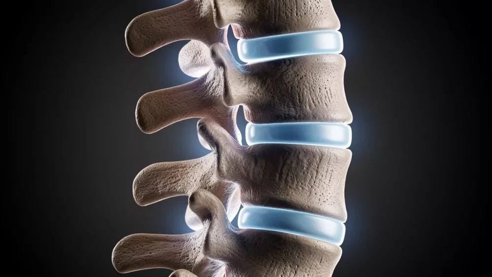 Detailed view of spinal vertebrae showing decompression and disc spacing